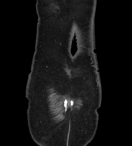 Acute uncomplicated sigmoid diverticulitis (Radiopaedia 82003-95987 Coronal C+ portal venous phase 152).jpg