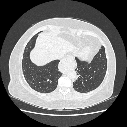 Adenocarcinoma in situ of lung (Radiopaedia 38685-40829 B 175).png