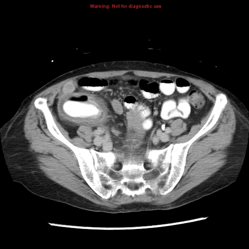 Adenocarcinoma of the colon (Radiopaedia 8191-9039 Axial renal excretory phase 42).jpg
