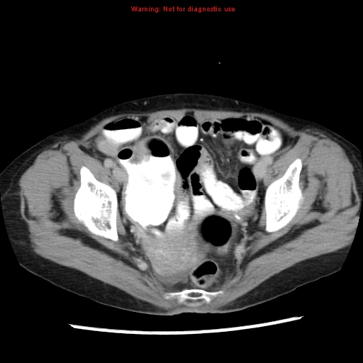 Adenocarcinoma of the colon (Radiopaedia 8191-9039 Axial renal excretory phase 52).jpg