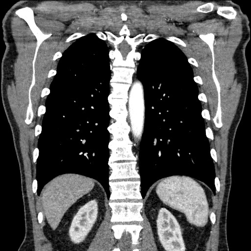Adenocarcinoma of the lung (Radiopaedia 59871-67325 Coronal C+ arterial phase 53).jpg