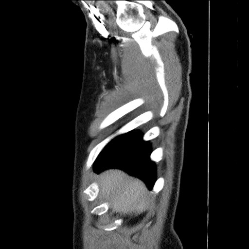Adenocarcinoma of the lung (Radiopaedia 59871-67325 Sagittal C+ arterial phase 4).jpg