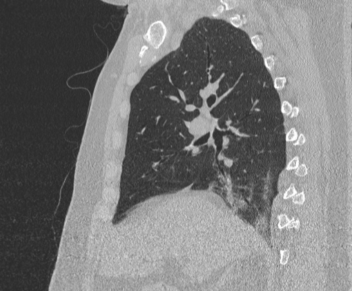 Adenoid cystic carcinoma of the trachea (Radiopaedia 49042-54137 Sagittal lung window 185).jpg