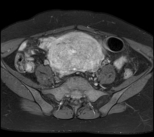 File:Adenomyosis - ovarian endometriomas (Radiopaedia 67031-76350 Axial T1 C+ fat sat 7).jpg