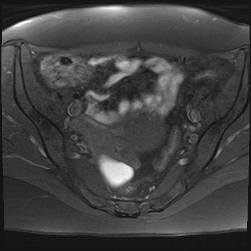 File:Adenomyosis and endometriotic cysts (Radiopaedia 82300-96367 Axial T1 fat sat 20).jpg