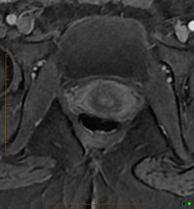 Adenomyosis uterus with hematometra (Radiopaedia 45779-50011 Axial T1 C+ fat sat 63).jpg