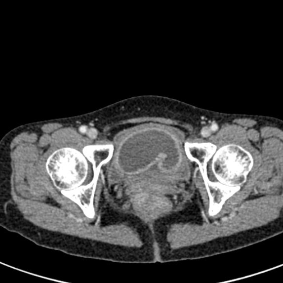 Adhesional small bowel obstruction (Radiopaedia 48397-53305 Axial C+ portal venous phase 90).jpg
