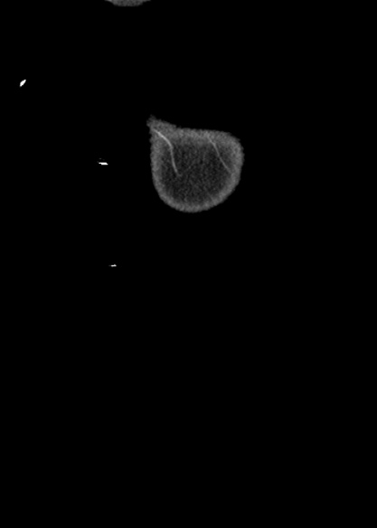 Adhesional small bowel obstruction (Radiopaedia 48397-53305 Coronal C+ portal venous phase 1).jpg