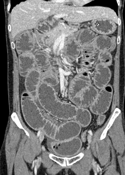 Adhesional small bowel obstruction (Radiopaedia 48397-53305 Coronal C+ portal venous phase 140).jpg