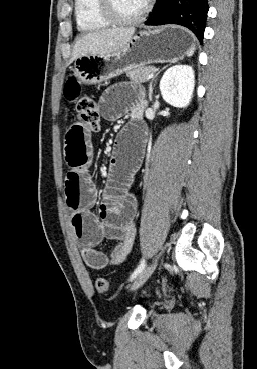 Adhesional small bowel obstruction (Radiopaedia 58900-66131 Sagittal C+ portal venous phase 158).jpg