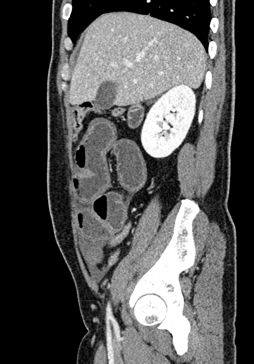 Adhesional small bowel obstruction (Radiopaedia 58900-66131 Sagittal C+ portal venous phase 69).jpg
