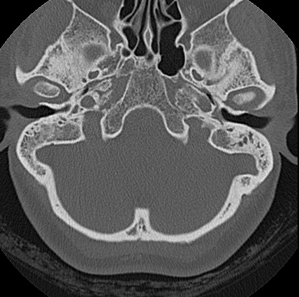 File:Adhesive chronic otitis media (Radiopaedia 14270-14148 Axial bone window 14).jpg
