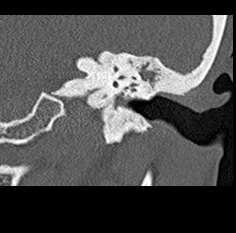 File:Adhesive chronic otitis media (Radiopaedia 14270-14148 Coronal bone window - left 17).jpg