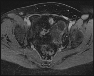 File:Adnexal multilocular cyst (O-RADS US 3. O-RADS MRI 3) (Radiopaedia 87426-103754 Axial 231).jpeg