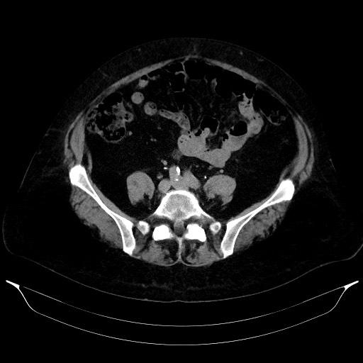 Adrenal cortical carcinoma (Radiopaedia 64017-72769 Axial C+ delayed 52).jpg