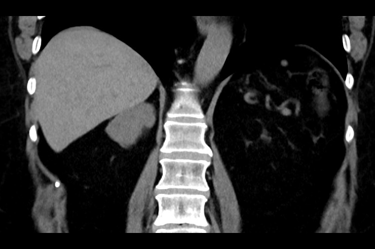 Adrenal cortical carcinoma (Radiopaedia 64017-72769 Coronal non-contrast 38).jpg