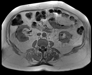 File:Adrenal cortical carcinoma (Radiopaedia 64017-72770 Axial T1 in-phase 49).jpg