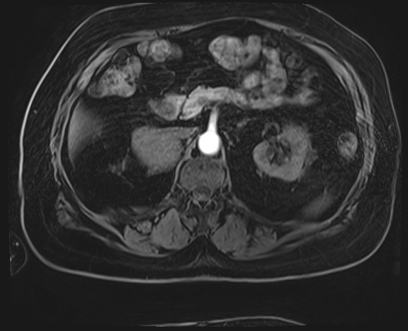 Adrenal cortical carcinoma (Radiopaedia 64017-72770 H 16).jpg