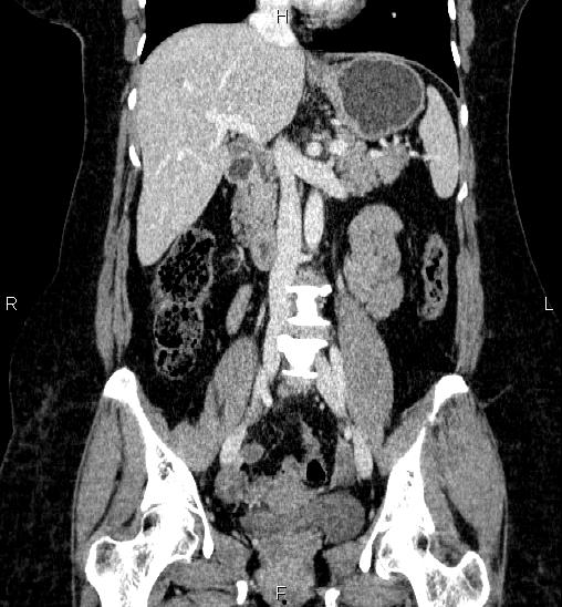 Adrenal cortical carcinoma (Radiopaedia 84882-100379 Coronal C+ portal venous phase 33).jpg