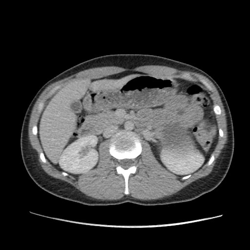 Adrenal cyst (Radiopaedia 64869-73813 Axial C+ portal venous phase 31).jpg