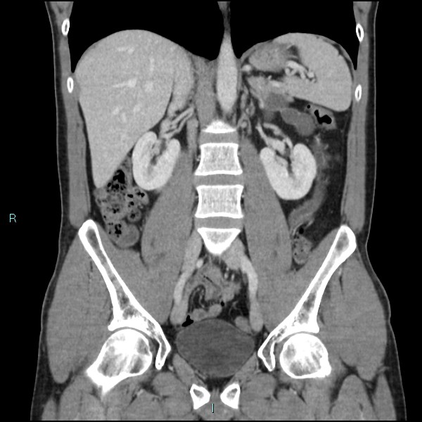 Adrenal cystic lymphangioma (Radiopaedia 83161-97534 Coronal C+ portal venous phase 41).jpg