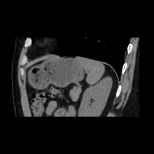Adrenal gland trauma (Radiopaedia 81351-95079 Sagittal non-contrast 77).jpg