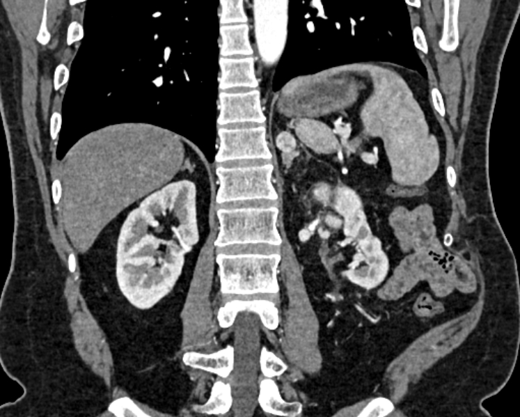 Adrenal metastases (Radiopaedia 73082-83791 Coronal C+ arterial phase 52).jpg