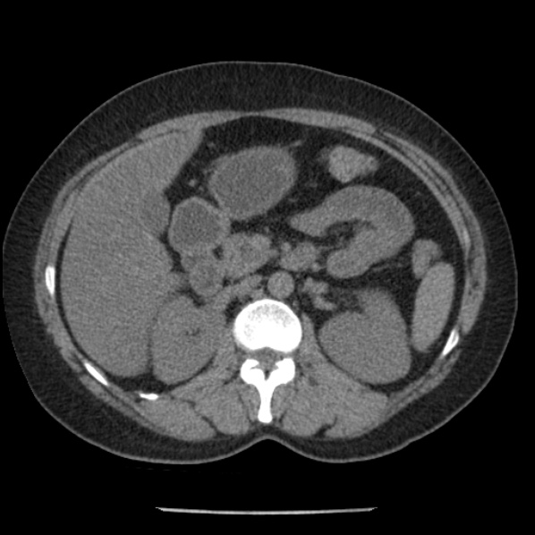 Adrenal myelolipoma (Radiopaedia 43401-46759 Axial non-contrast 33).jpg
