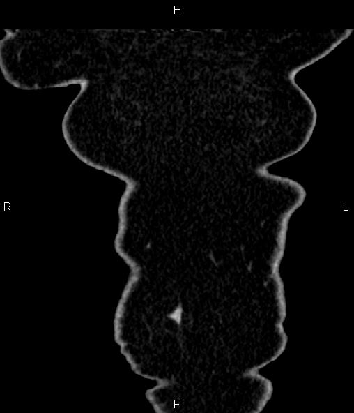 Adrenal myelolipoma (Radiopaedia 82742-96986 Coronal renal cortical phase 5).jpg