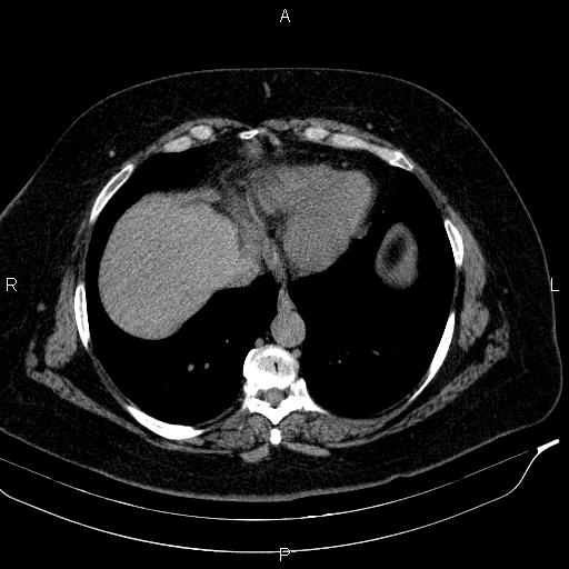 Adrenal myelolipoma (Radiopaedia 84319-99617 Axial With oral contrast 22).jpg