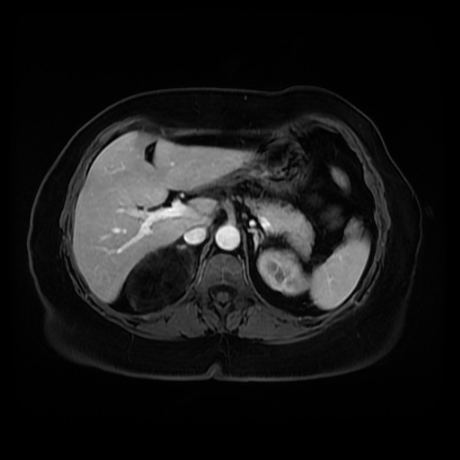 Adrenal myelolipoma - MRI (Radiopaedia 83249-97646 T1 fat sat arterial phase 28).jpg