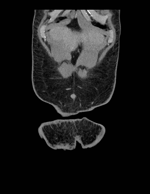Adrenal myelolipoma - bilateral (Radiopaedia 74805-85810 Coronal C+ portal venous phase 245).jpg