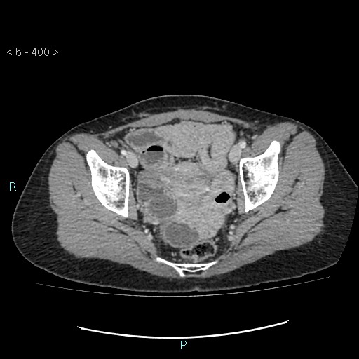 Adult transient intestinal intussusception (Radiopaedia 34853-36310 Axial C+ portal venous phase 104).jpg