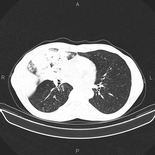 Air bronchogram in pneumonia (Radiopaedia 85719-101512 Axial lung window 37).jpg