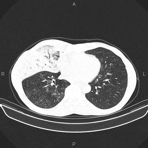 Air bronchogram in pneumonia (Radiopaedia 85719-101512 Axial lung window 43).jpg
