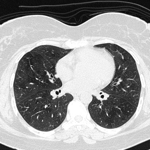 Air trapping in small airway disease (Radiopaedia 61685-69694 Axial lung window 87).jpg
