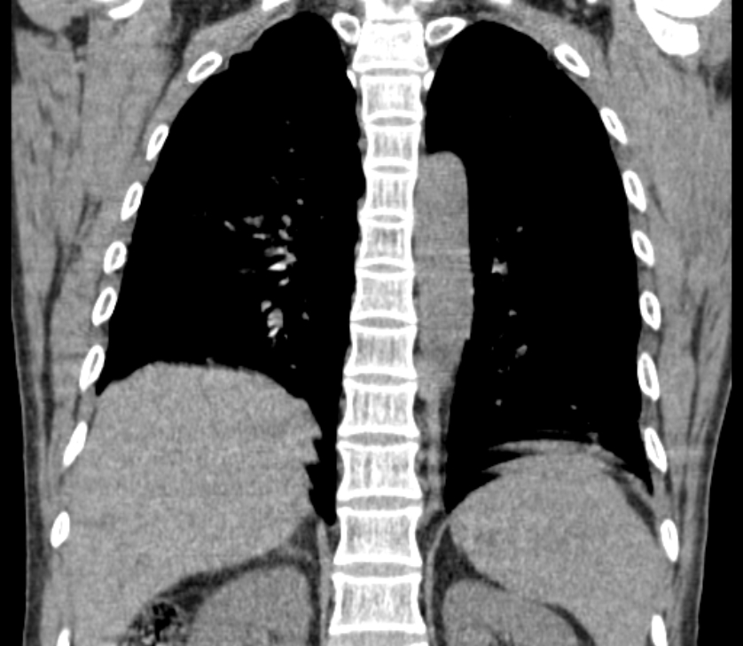 Airway foreign body in adult (Radiopaedia 85907-101779 Coronal liver window 188).jpg