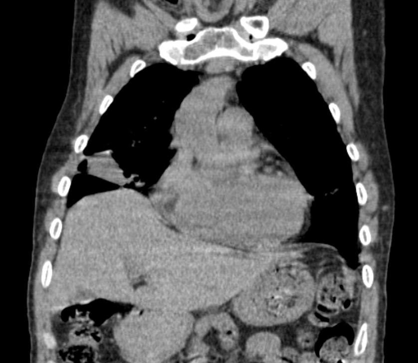 Airway foreign body in adult (Radiopaedia 85907-101779 Coronal liver window 73).jpg