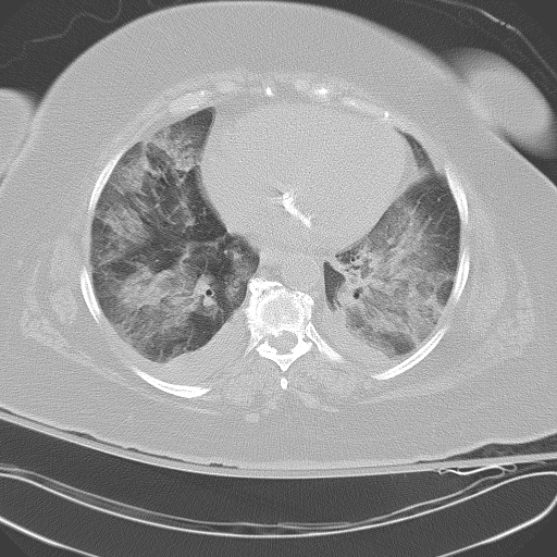 All trans retinoic acid (ATRA) syndrome (Radiopaedia 38212-40229 Axial lung window 37).jpg