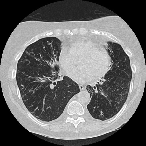 Alpha-1-antitrypsin deficiency (Radiopaedia 72058-82557 Axial lung window 46).jpg