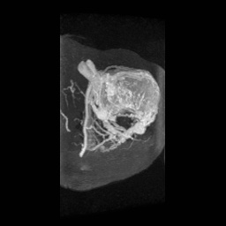 Alveolar soft part sarcoma (Radiopaedia 64501-73678 D 10).jpg