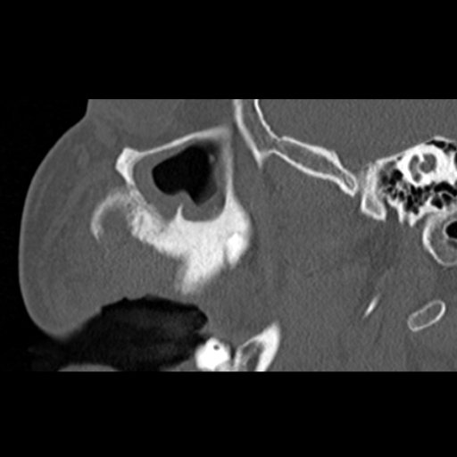 File:Ameloblastic fibro-odontoma (Radiopaedia 18843-18780 bone window 12).jpg