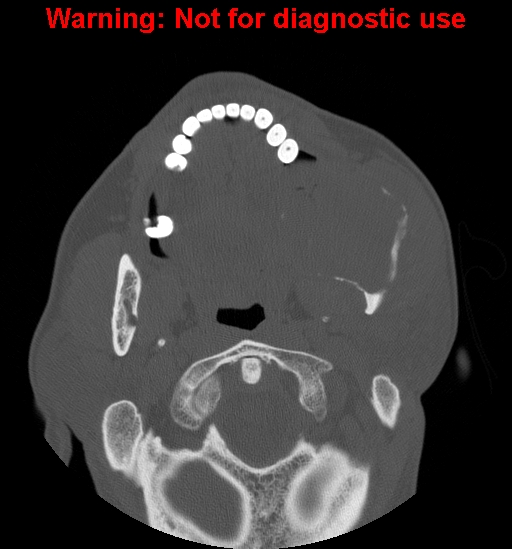 File:Ameloblastoma (Radiopaedia 13276-13280 Axial non-contrast 14).jpg