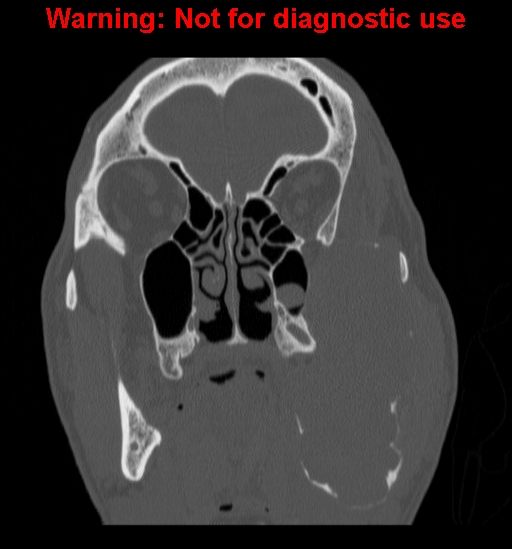 File:Ameloblastoma (Radiopaedia 13276-13280 Coronal non-contrast 12).jpg