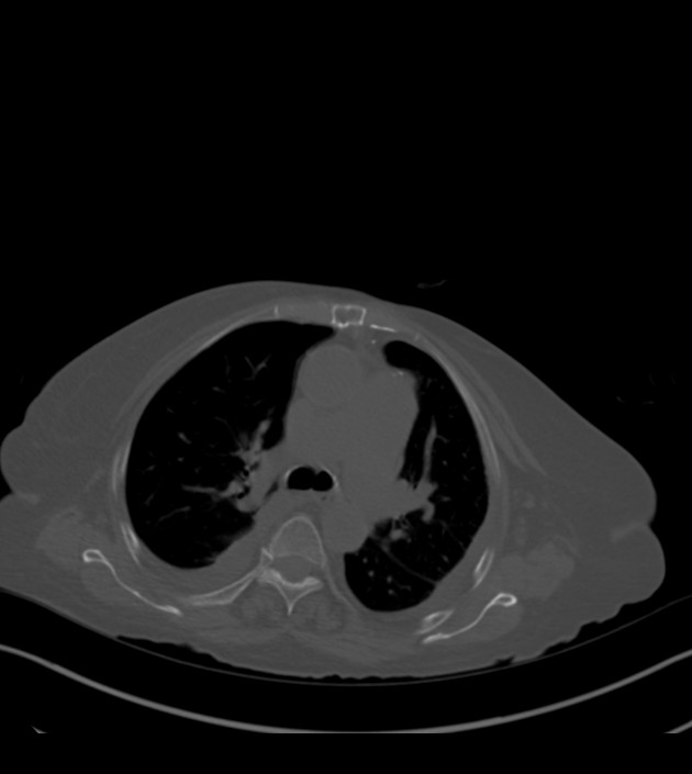 Amiodarone deposition in the liver (Radiopaedia 77587-89780 Axial bone window 31).jpg