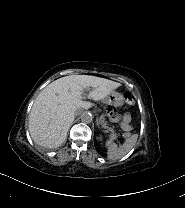 Amiodarone deposition in the liver (Radiopaedia 77587-89780 Axial non-contrast 80).jpg
