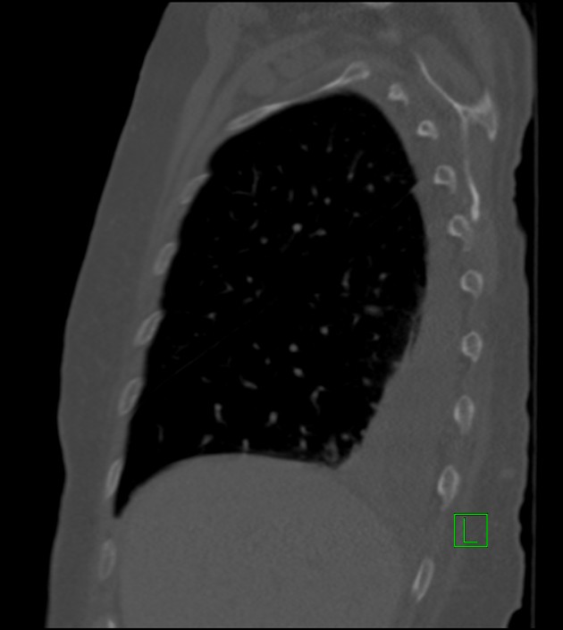 Amiodarone deposition in the liver (Radiopaedia 77587-89780 Sagittal bone window 76).jpg