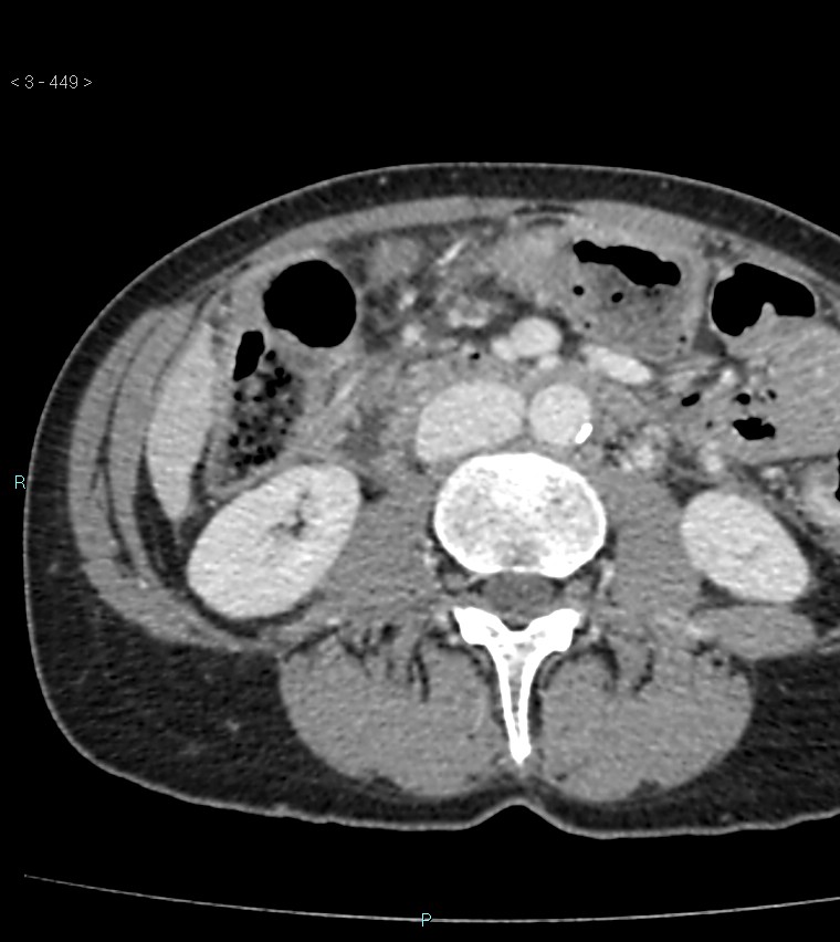 Ampulla of Vater metastasis (Radiopaedia 27820-28065 A 53).jpg