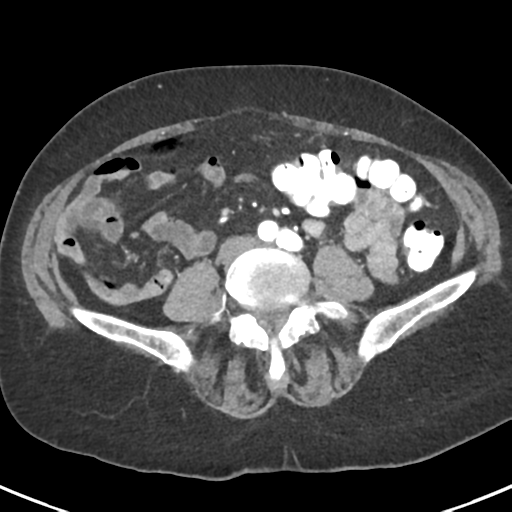 Ampullary adenocarcinoma (Radiopaedia 34013-35237 B 63).png