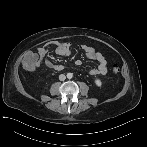Ampullary adenocarcinoma (Radiopaedia 59373-66737 A 95).jpg